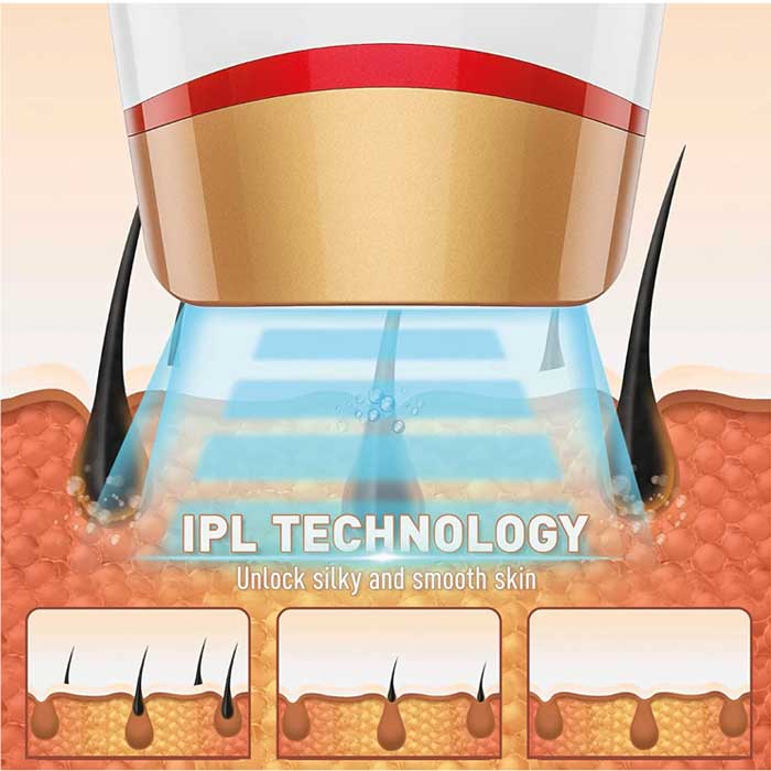 מסיר שיער IPL